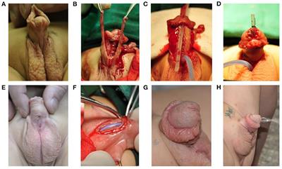 Comparison of Penile Appearance and Outcomes Between Prefabricated Urethra and Pre-implanted Urethral Plate for Treatment of Children With Severe Hypospadias: A Retrospective Study